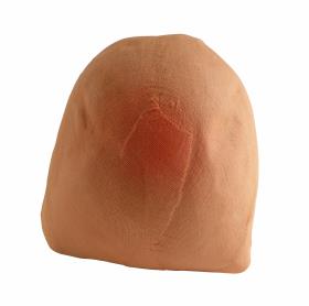 Glatze