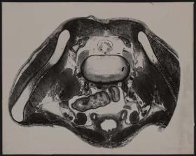 Beckenquerschnitt. Foet Mens 4. Descensus Testiculorum.